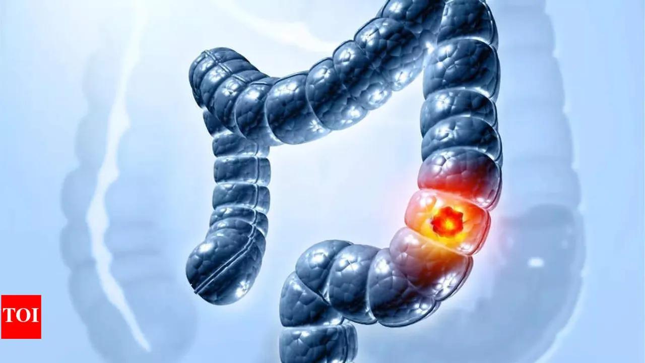 Colon Cancer Surge In Young Adults: Doctor Highlights Warning Signs Image