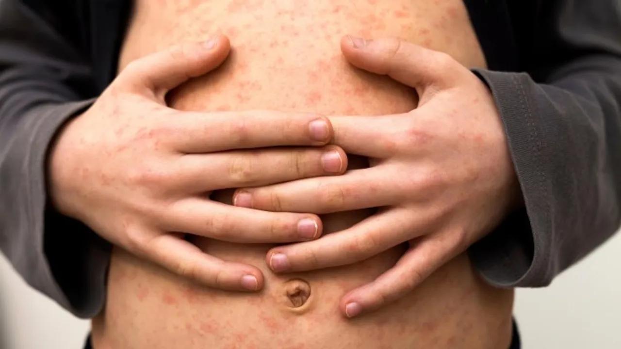 Measles Cases Surge In Europe Amid Declining Vaccine Rates Image