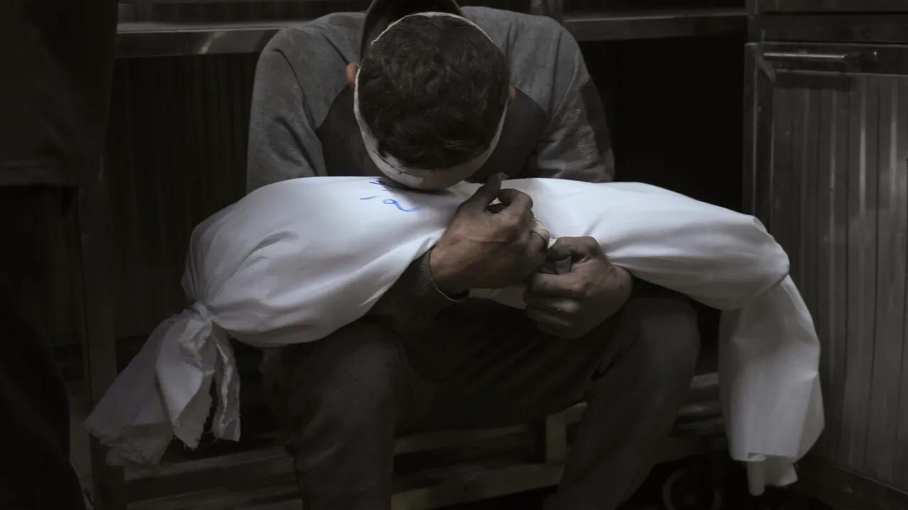 Un Reports Rising Child Malnutrition In Gaza Amid Israeli Strikes Image