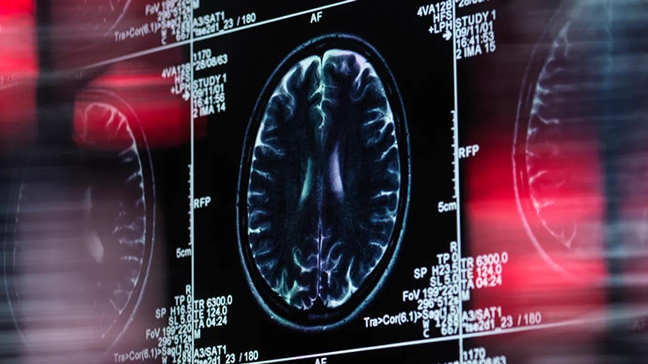 Gabapentin For Back Pain Linked To Increased Dementia Risk Image