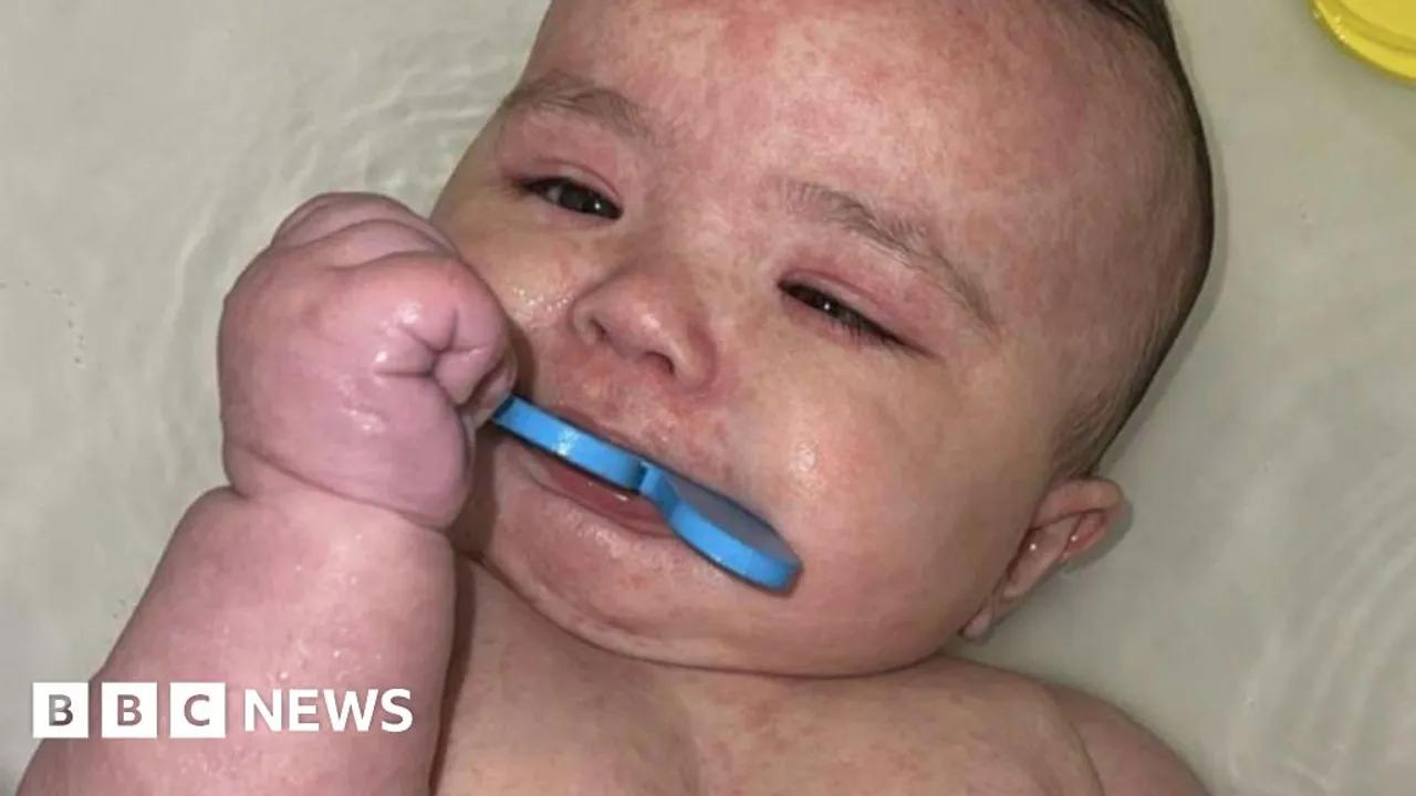 Canada Faces Major Measles Outbreak Amid Vaccine Hesitancy Image