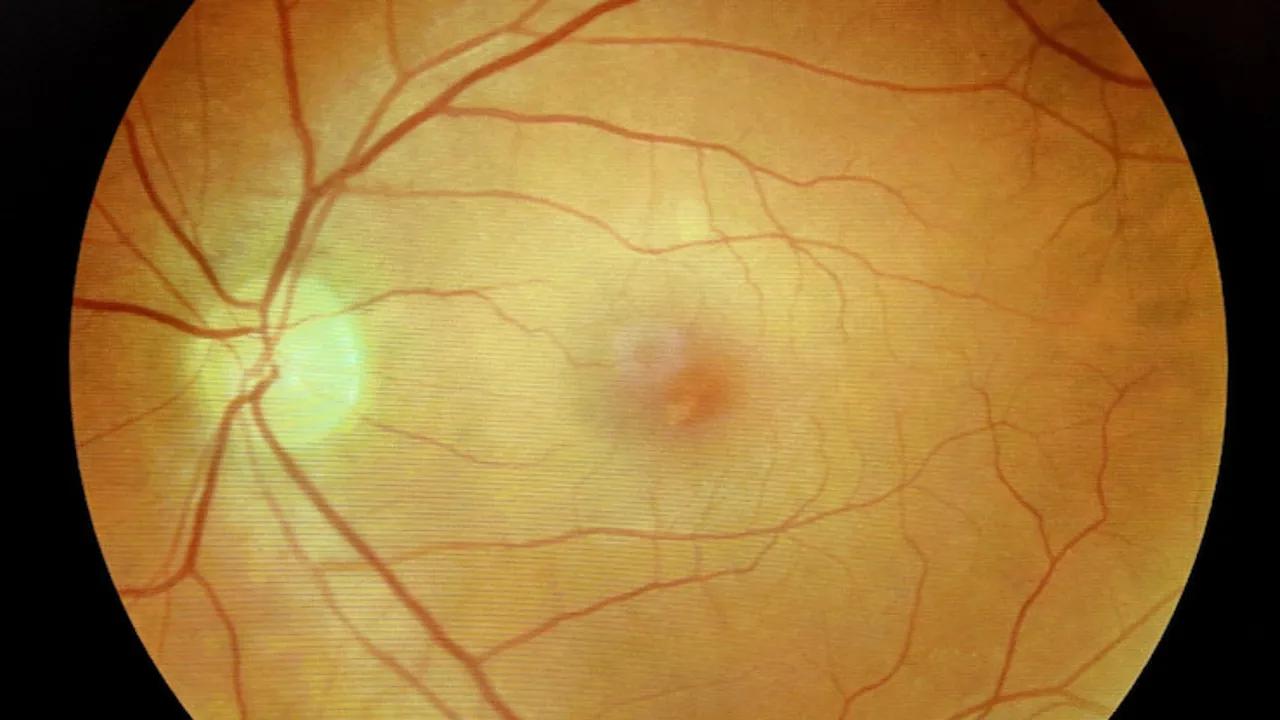 Covid-19 May Lead To Alzheimer's-like Plaques In Brain And Eyes Image