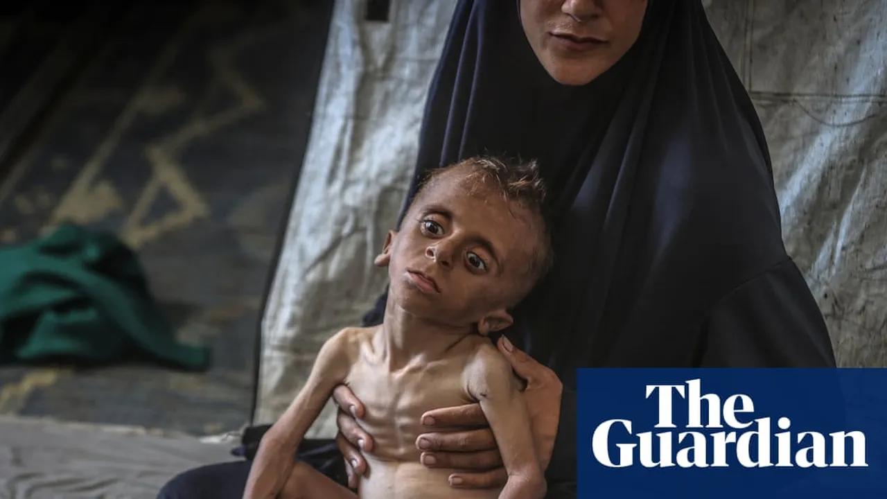 Gaza Clinic Reports Tripling Of Severe Malnutrition In Children Under Five Image