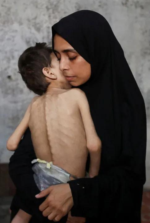 The Impact Of Hunger On Gaza's Starving Population Image