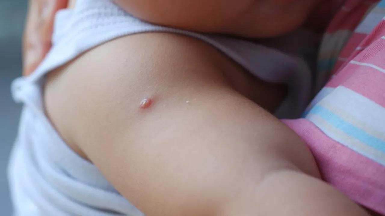 Molluscum Enfeksiyonu: Yaz Aylarında Çocuklarda Artış Gösteren Viral Tehdit Image
