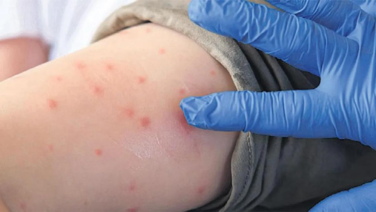 Çin'de Chikungunya Virüsü Alarmı: Önleme Uyarıları Image