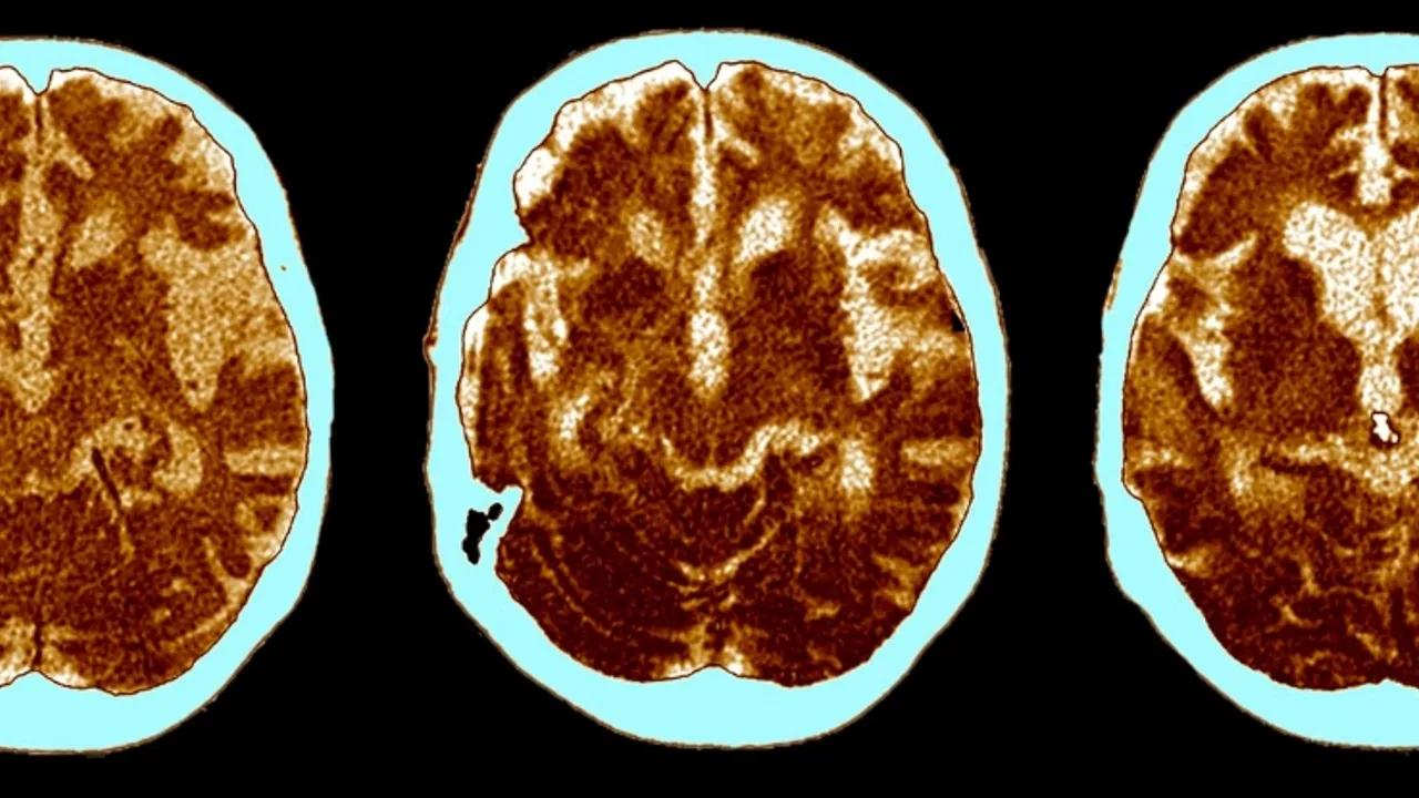 Study Suggests Shingles Vaccine May Reduce Dementia Risk by 20% Image