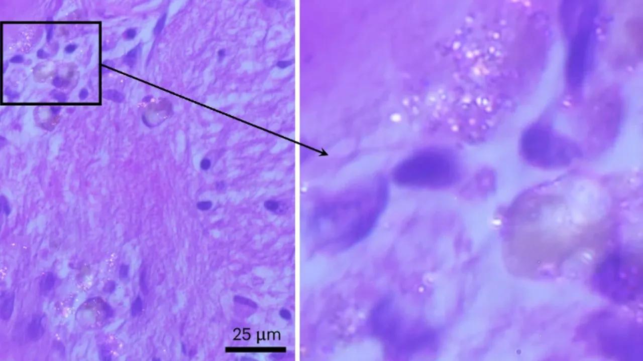 The Impact of Microplastics on Human Brain Health Image