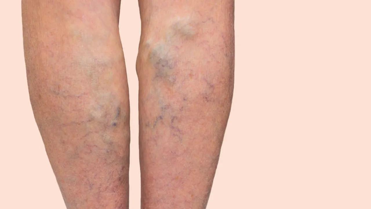 Damar Sağlığı: Varis ve Tromboz Risklerine Karşı Alınması Gereken Önlemler Image