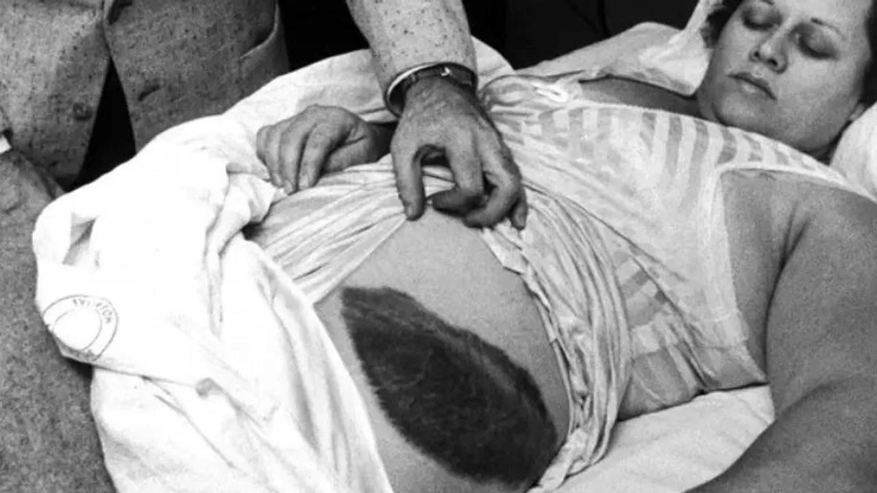 First Documented Human Meteorite Impact: A 70-Year-Old Intriguing Tale Image